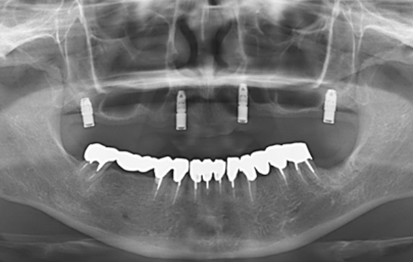 インプラントオーバーデンチャー症例